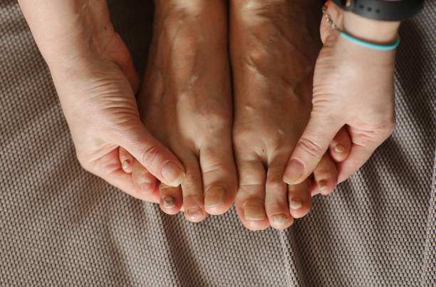 Why Home Remedies Rarely Work for Fungal Nails